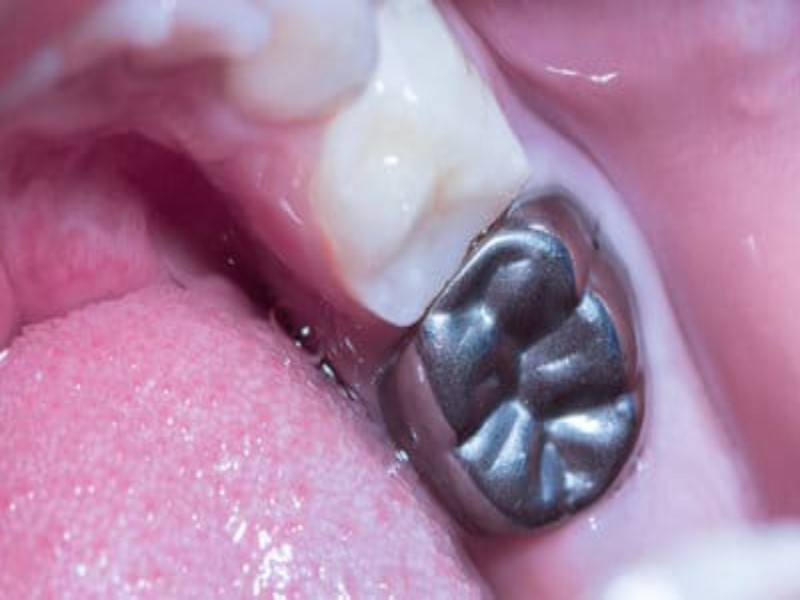 Baby teeth filling vs crown