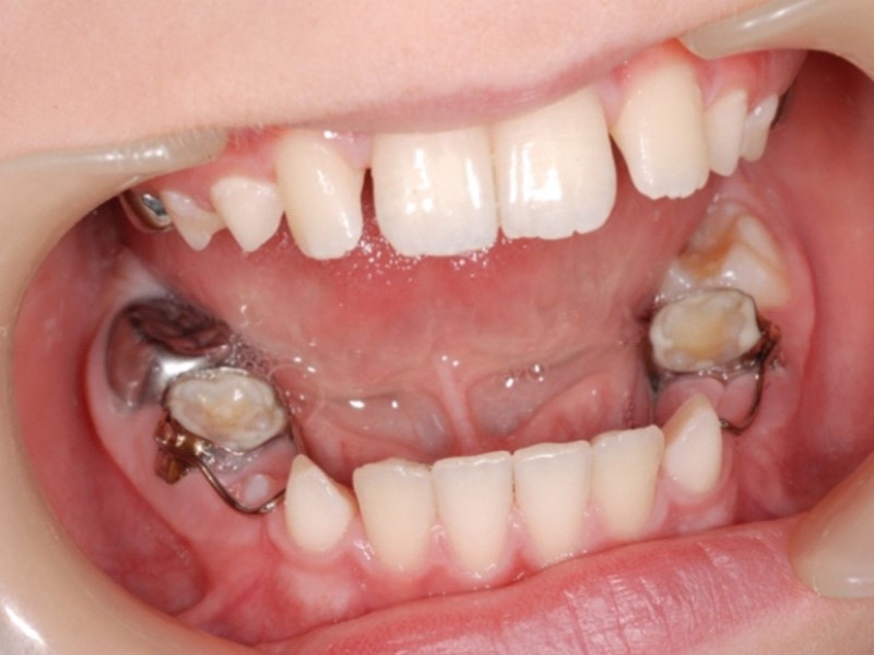المحافظ على المسافة لأسنان الأطفال