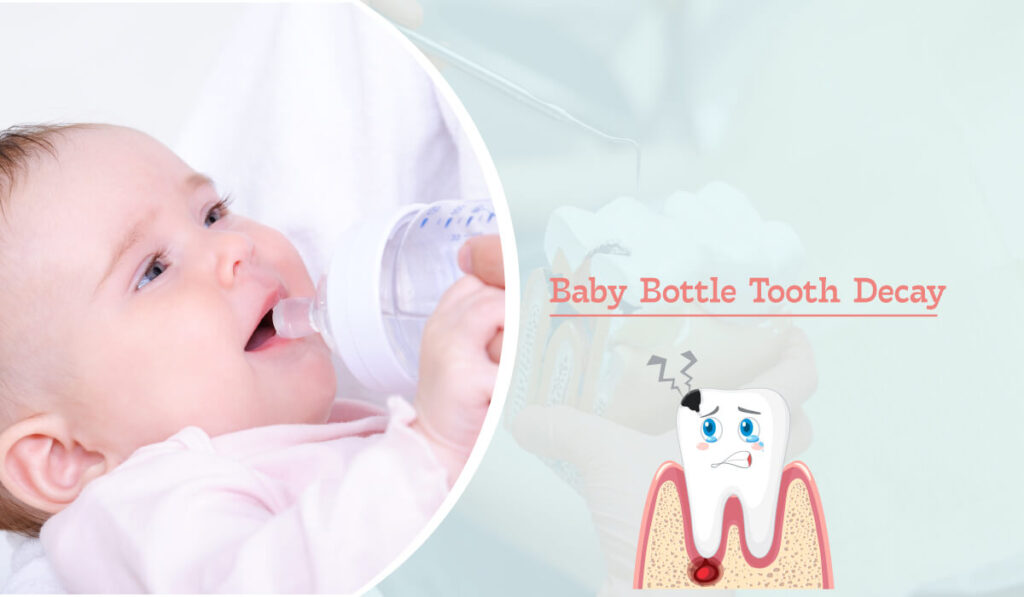 Baby Bottle Tooth Decay