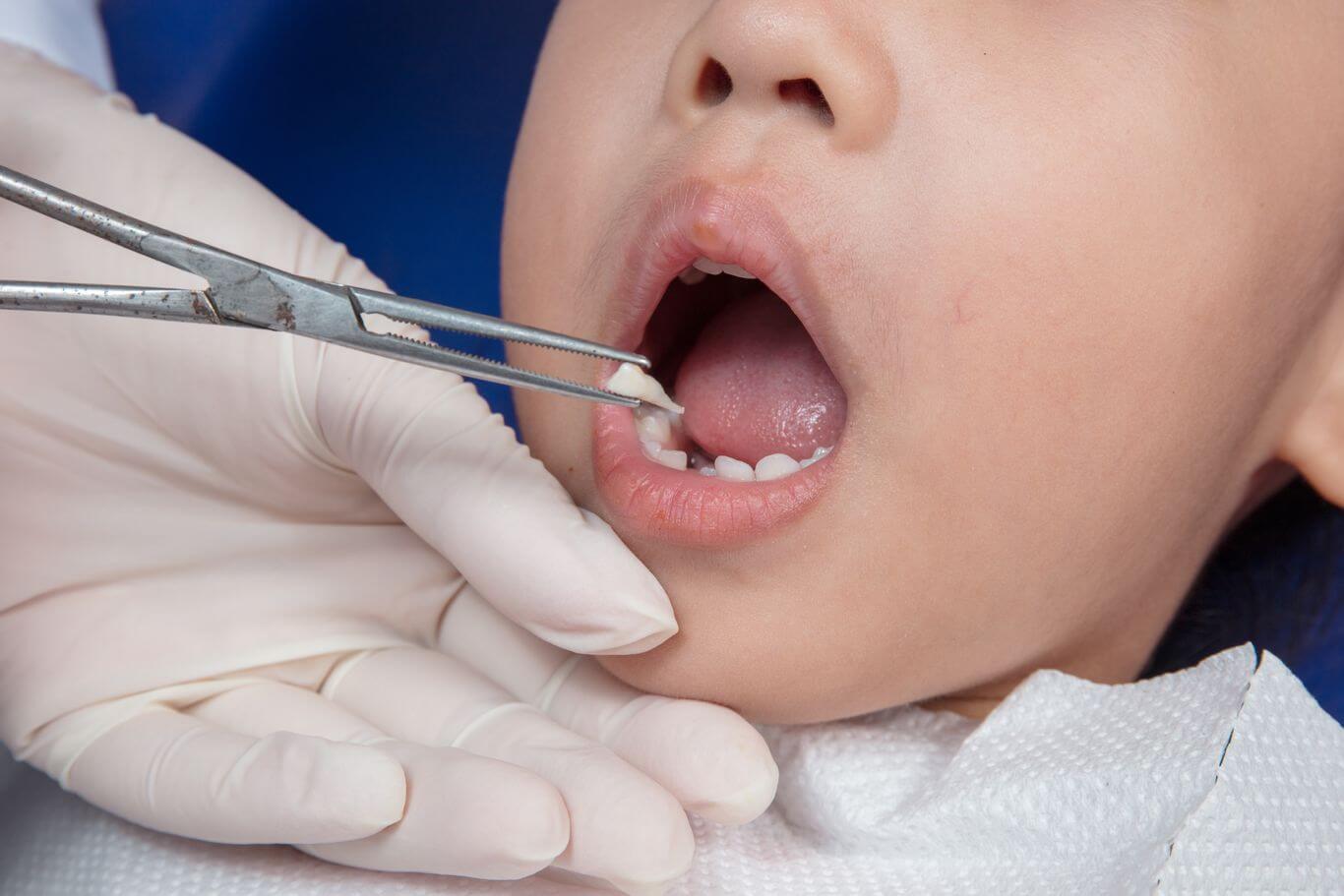 children's tooth extraction types