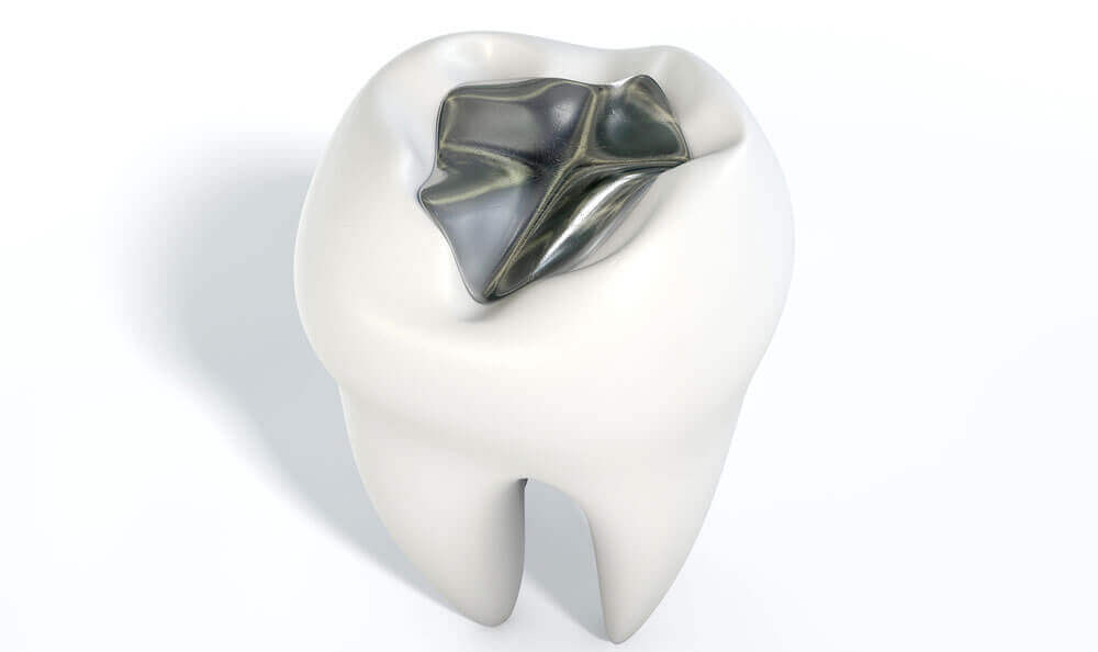 Amalgam Fillings