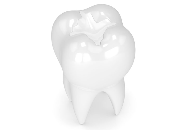 Composite Fillings