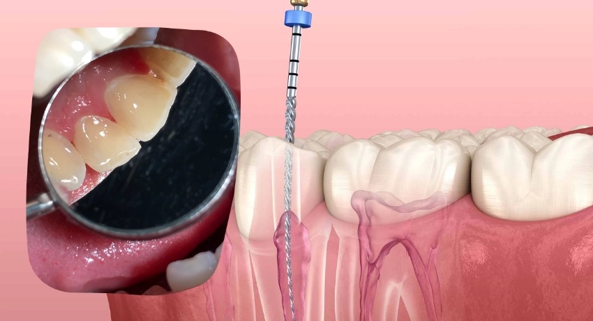 root canal treatment guide