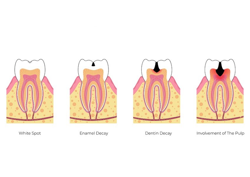 stages of dental cavity in kids