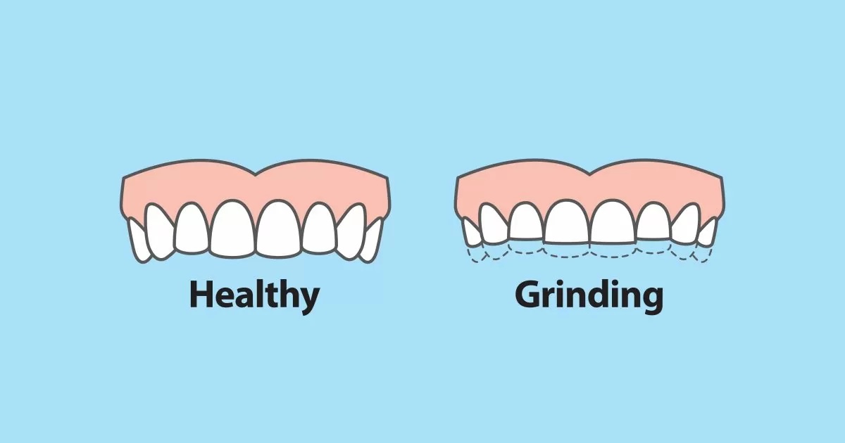 Teeth Grinding in Children