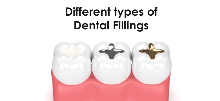 types of dental filling for children