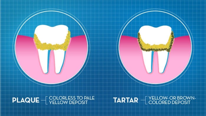 what differences between dental plaque vs tartar