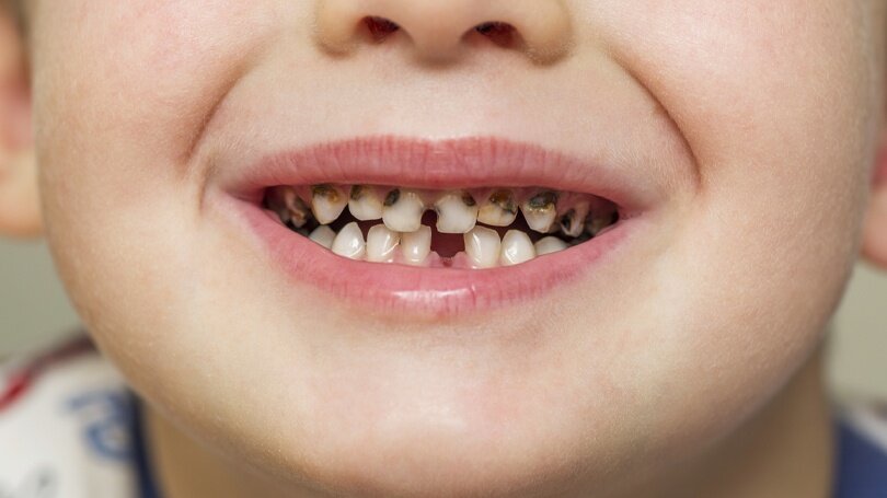 Ways to Prevent Tooth Cavities in Kids