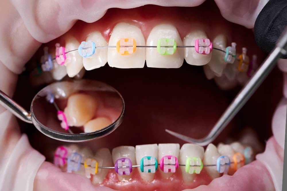 braces for kids