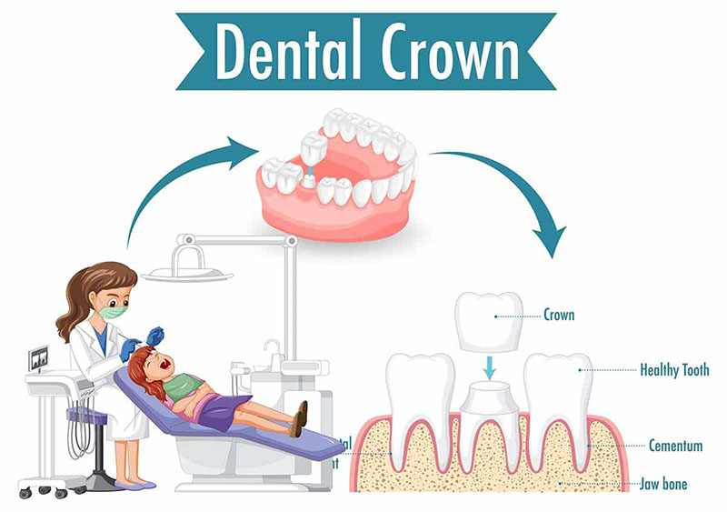 Child Dental Crown Procedure