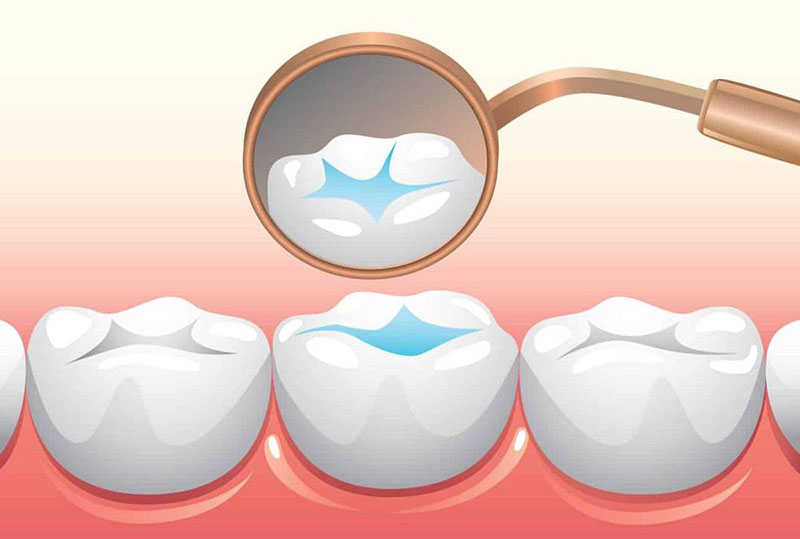 Best Age for Dental Sealants