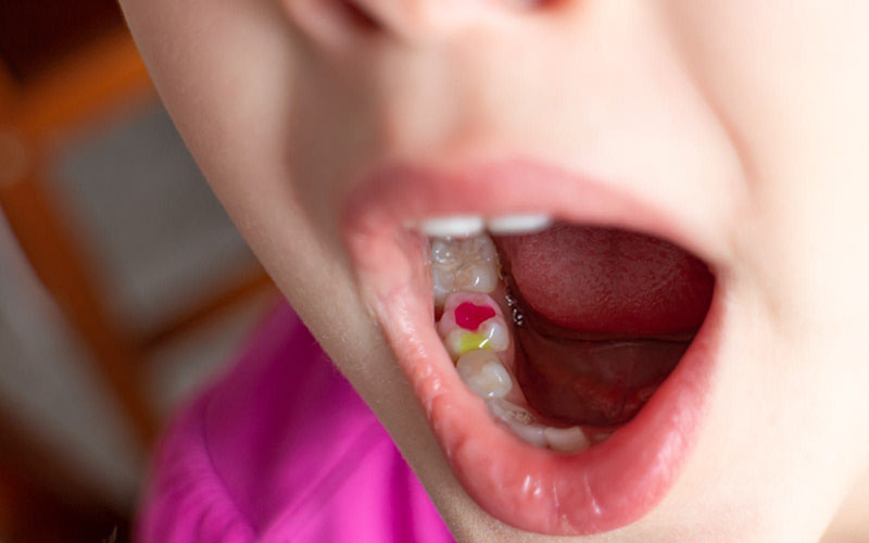 Best Cavity Filling Options for Kids in dubai