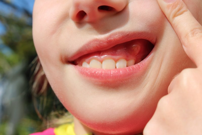 Swollen Gums in Kids in dubai