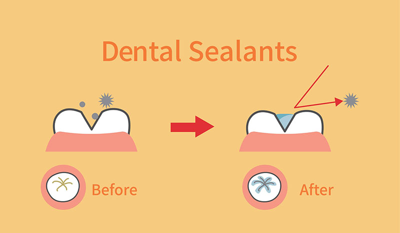 before and after of dental sealants in kids