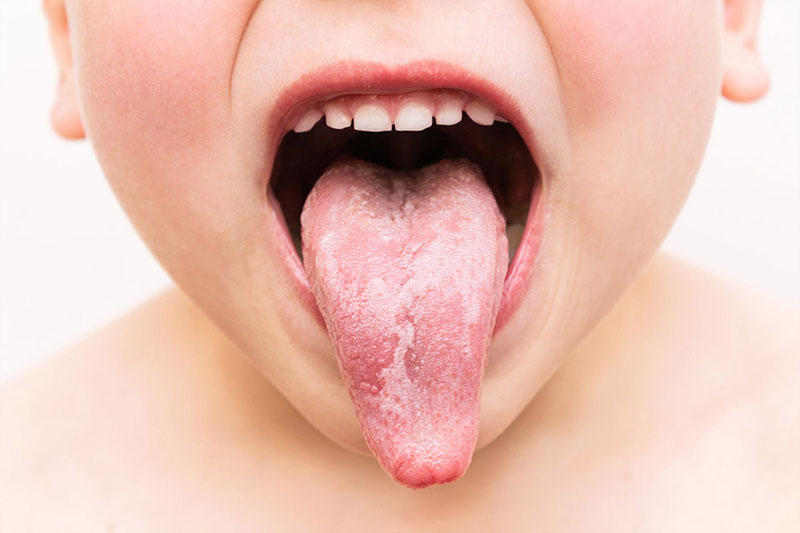 Dry Mouth in Kids