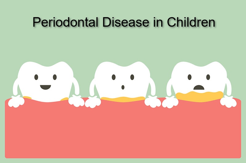 Periodontal Disease in Children in dubai