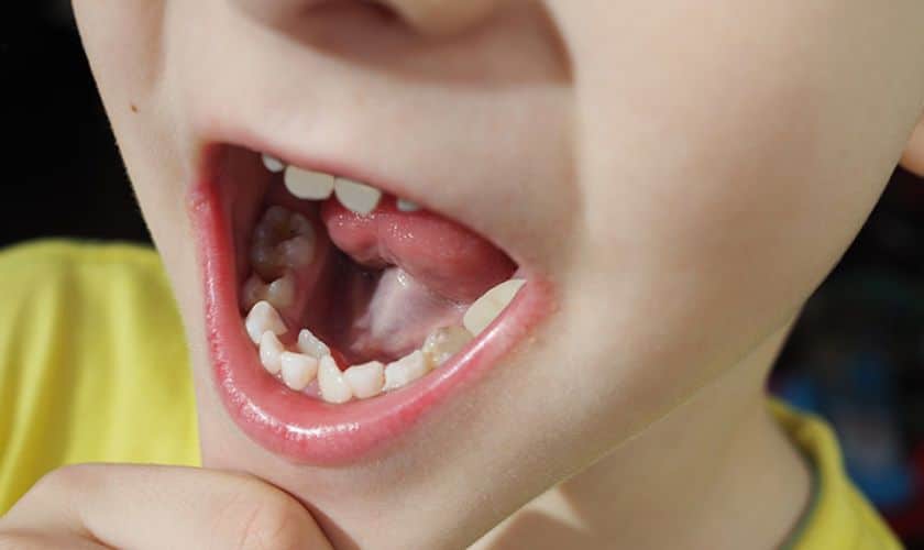 Supernumerary Tooth in children in dubai