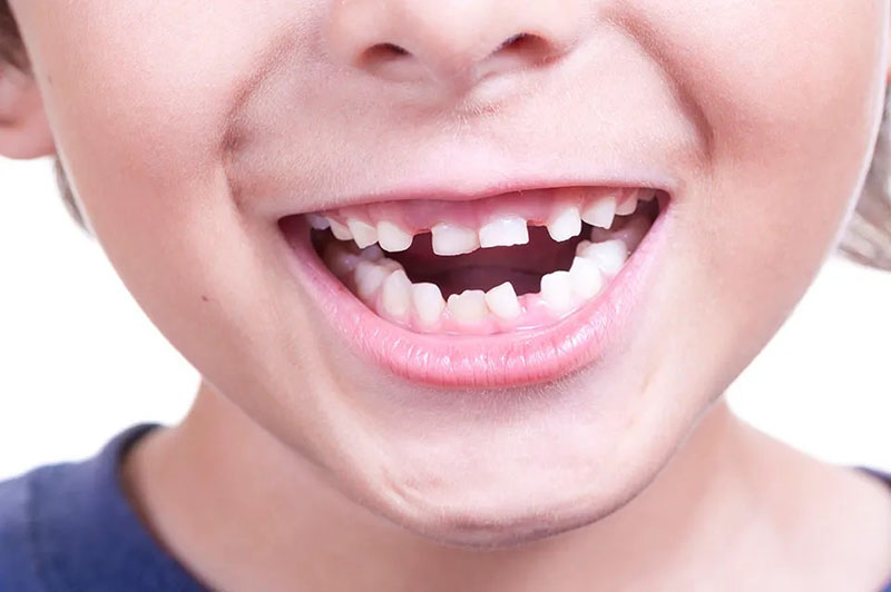 Tooth Misalignment in Children in dubai