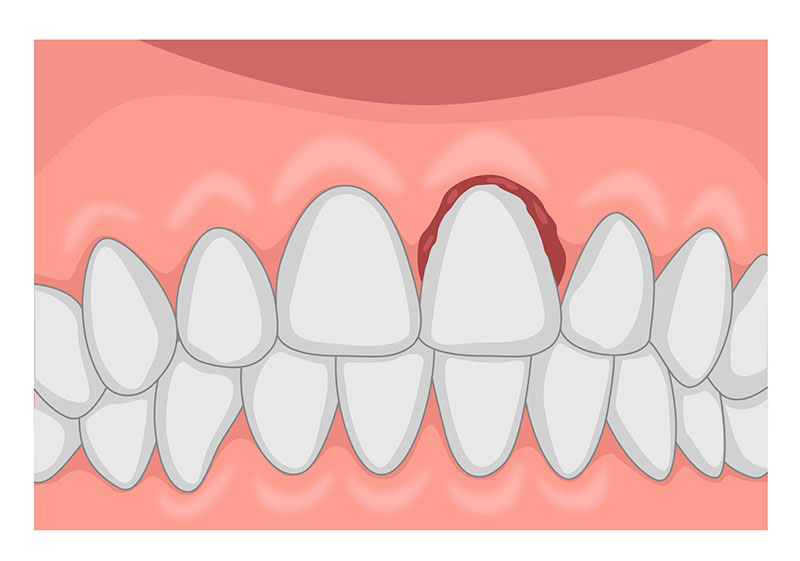 Tooth Subluxation in Children in dubai