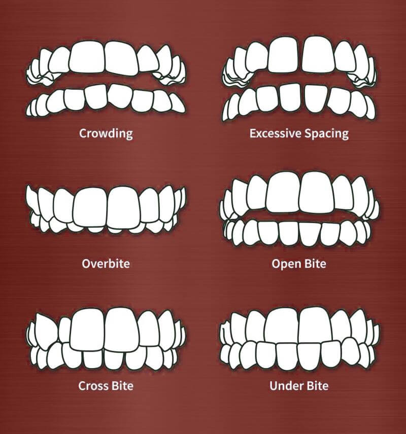 Types of Tooth Misalignment