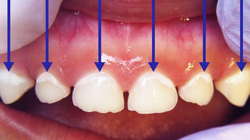 White Spots on Baby Teeth in dubai