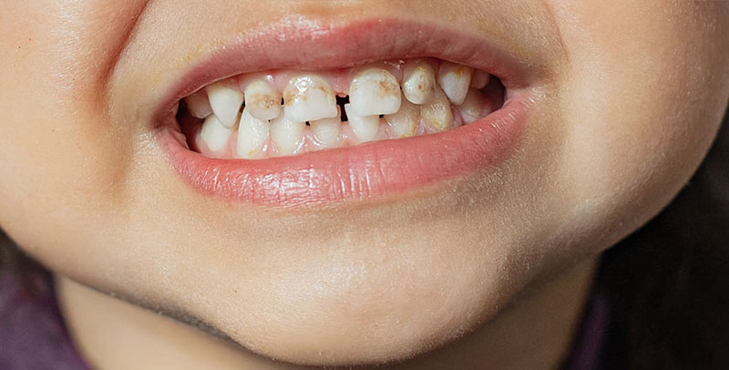 Enamel Hypoplasia in children in dubai