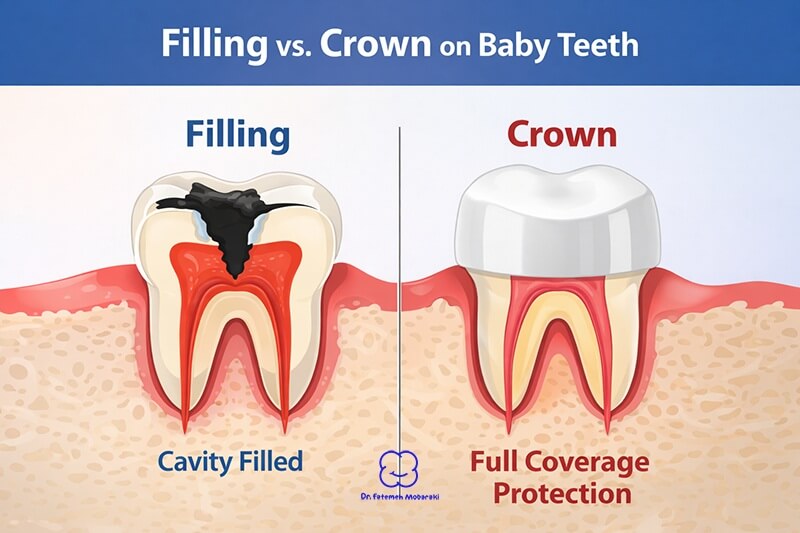 differences between filling and crown on baby teeth